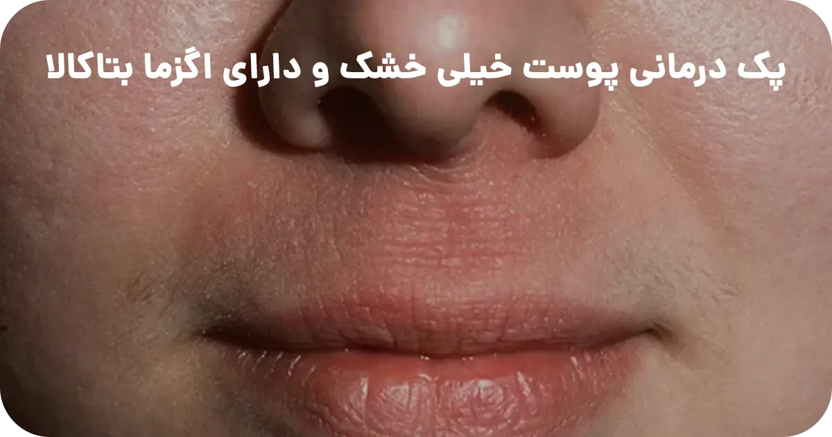پک درمانی پوست خیلی خشک و دارای اگزما بتاکالا