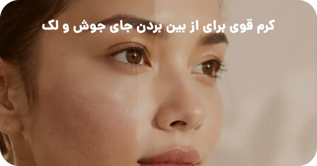 کرم قوی برای از بین بردن جای جوش و لک