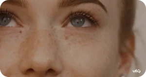 نحوه استفاده از کرم قوی برای از بین بردن جای جوش و لک
