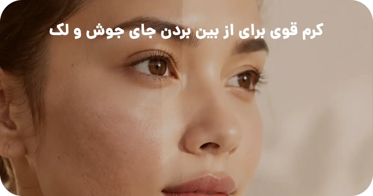کرم قوی برای از بین بردن جای جوش و لک